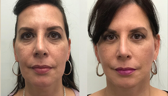 What Face Lift Do | GalloMD