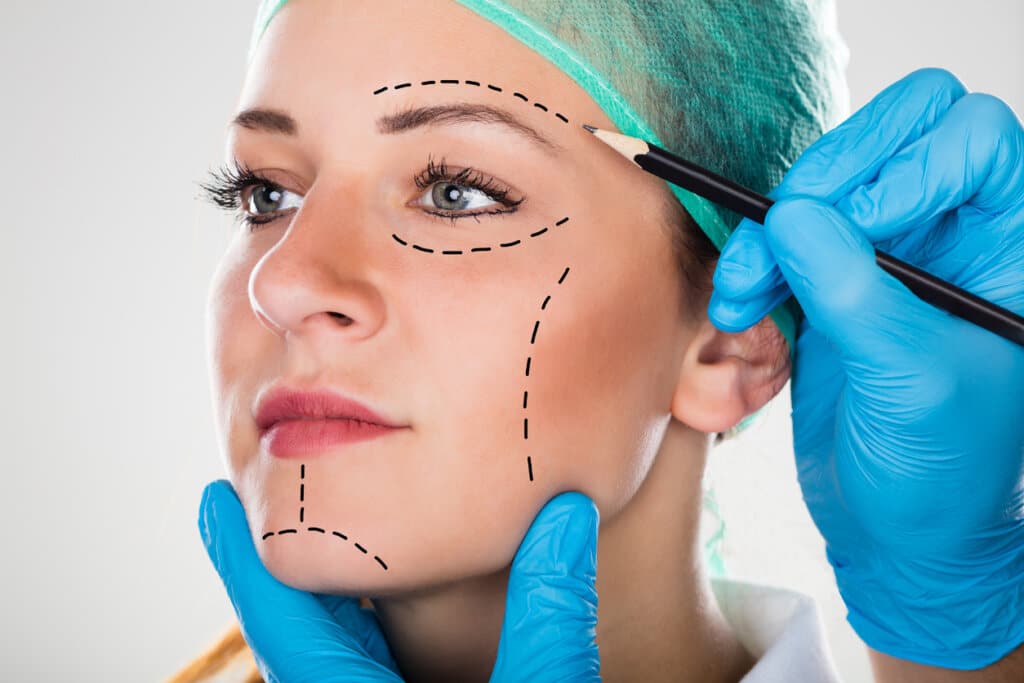Miami’s top facelift surgeon: Drawing perforation lines on female patient’s face.
